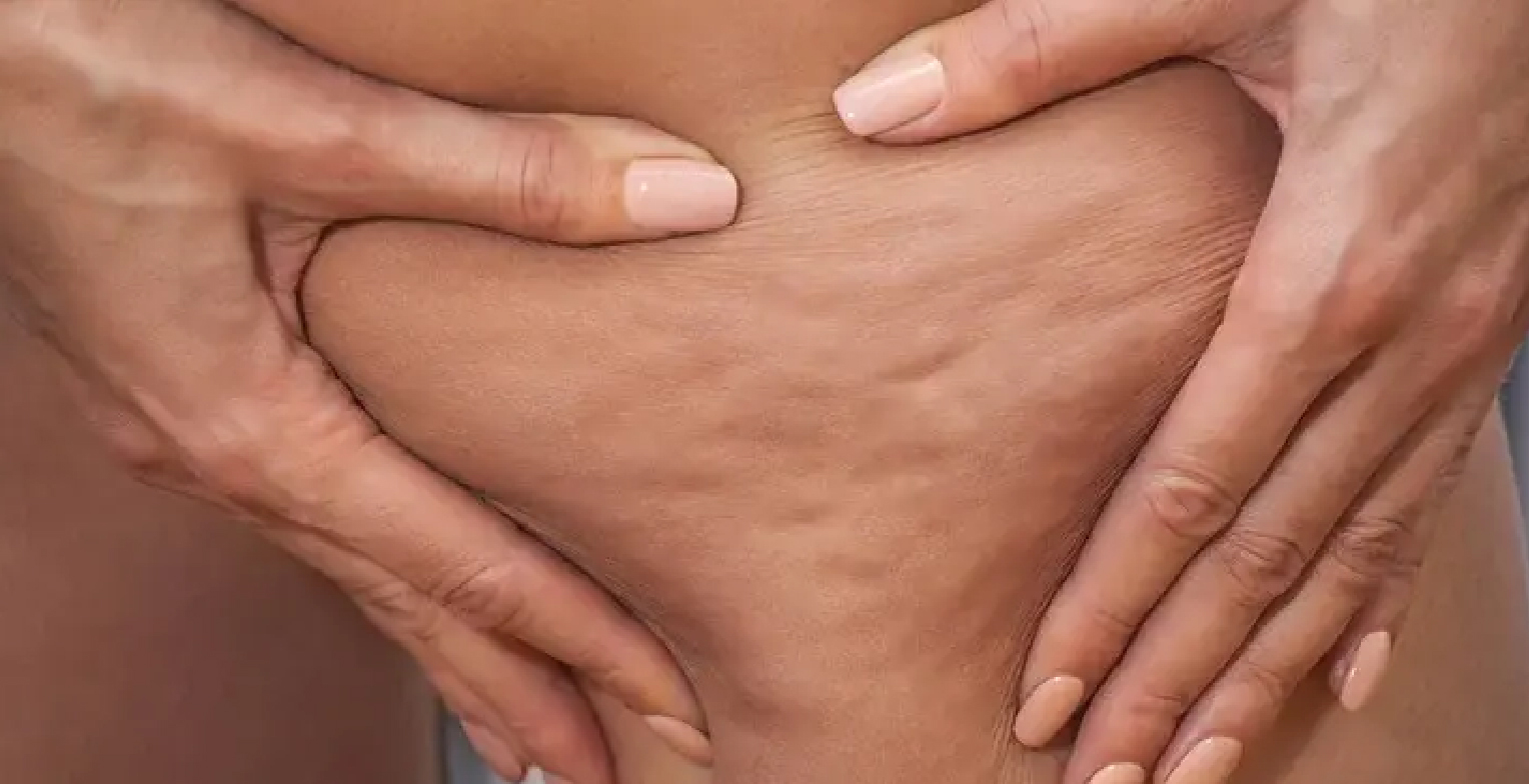How to get rid of cellulite: 15 expert tips from dermatologists